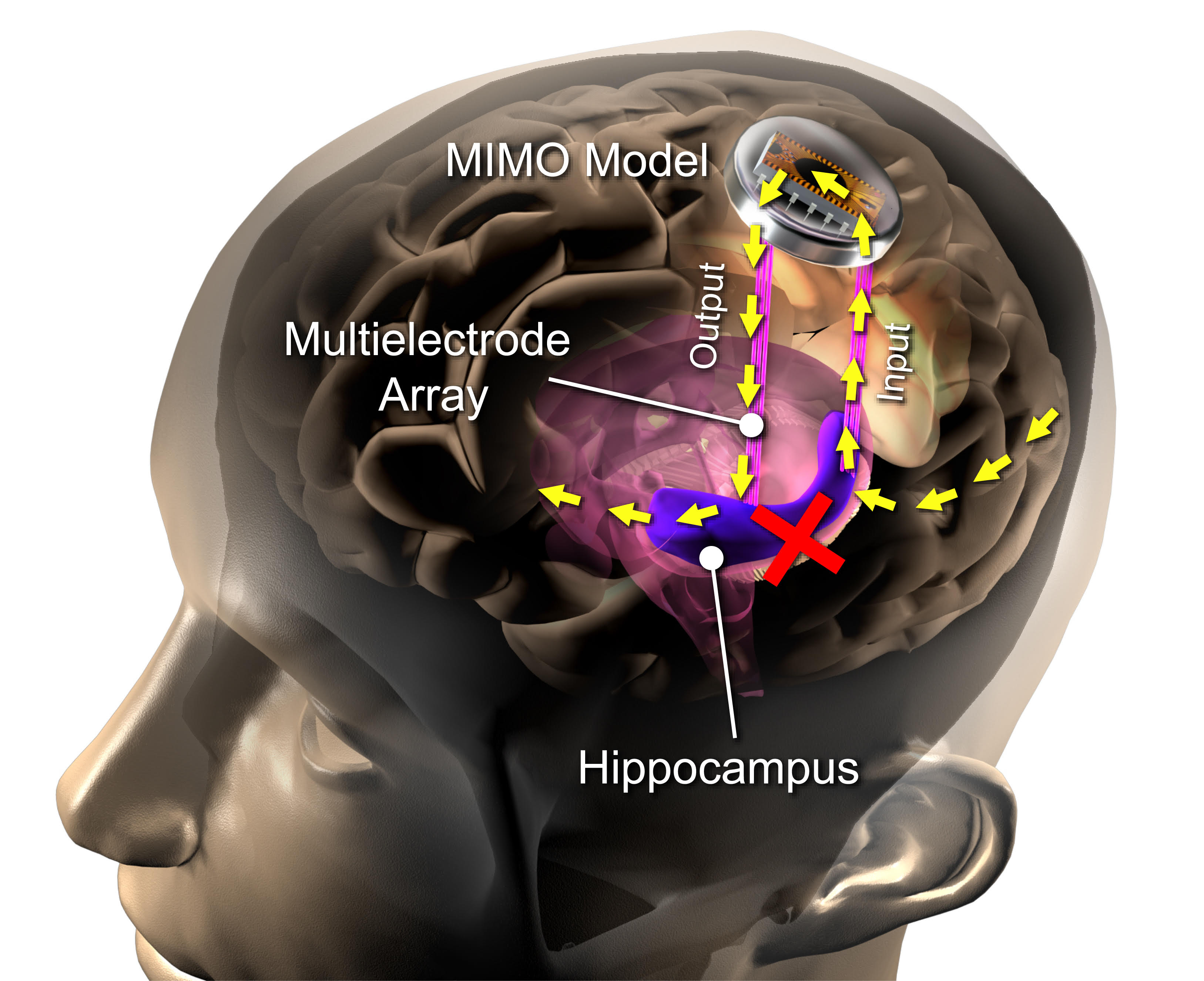 Brain 89. Мозг человека гиппокамп. Вживленные в гиппокамп электроды. Мозговые протезы гиппокамп.